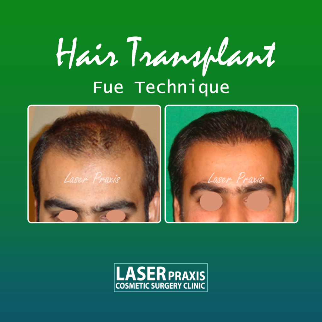 Hair Transplant | Laser Praxis